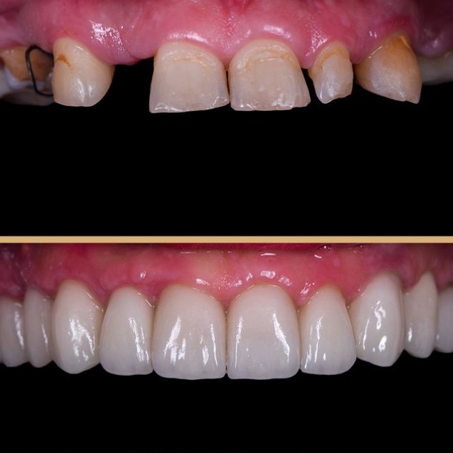 Rehabilitación oral completa