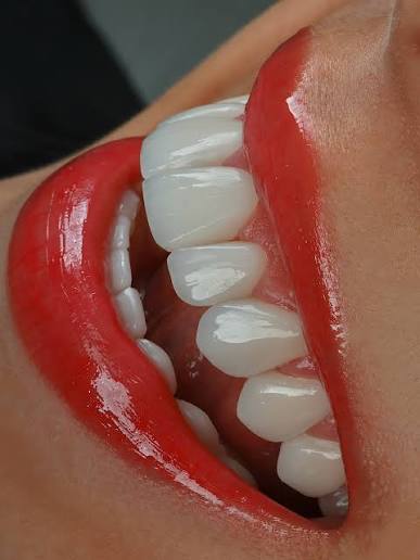 Diseño de sonrisa