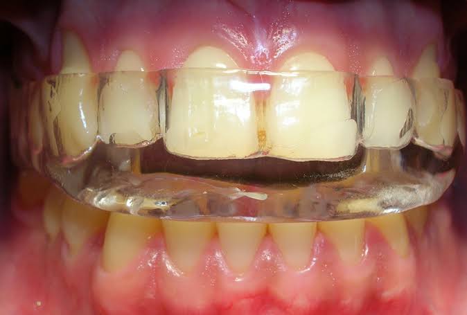 Placas neuromiorelajantes