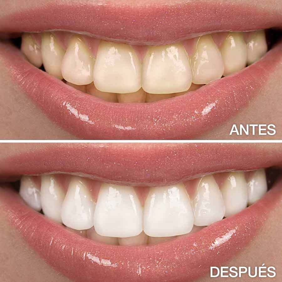 Aclaramiento dental